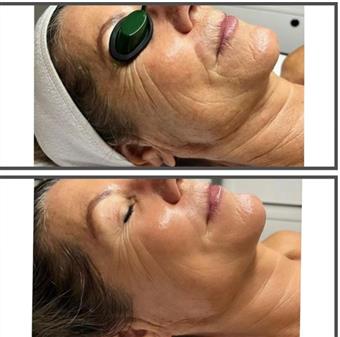 Korean "Needle Free Filler Facial"